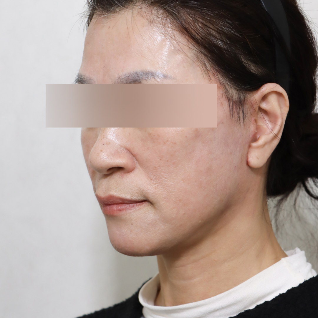 안면거상술 after측면 이미지