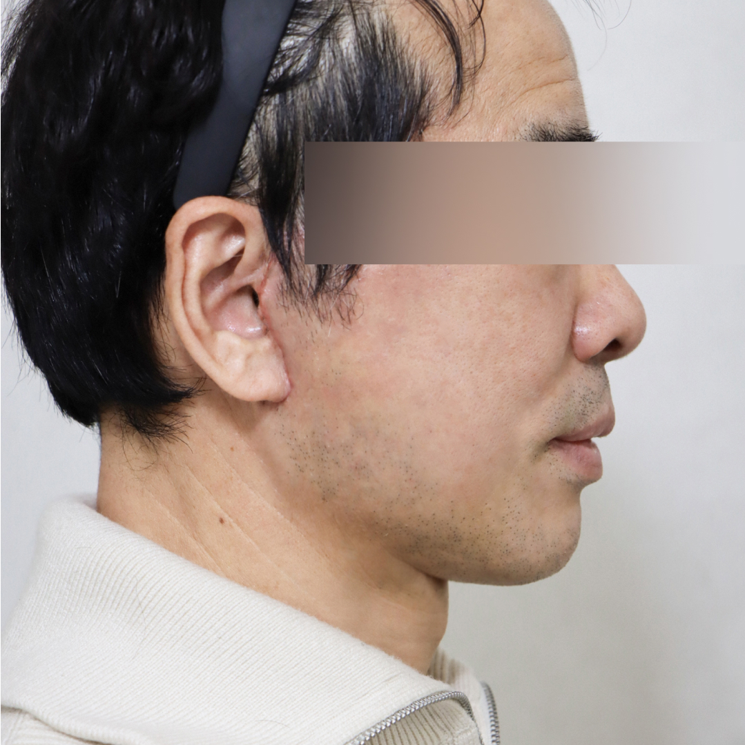 안면거상술 after 90도 이미지