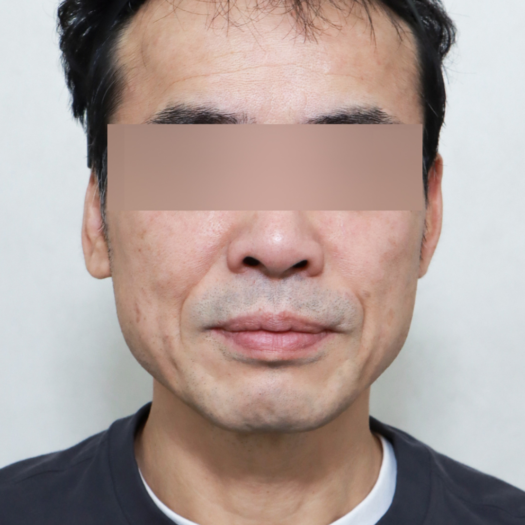 안면거상술 before정면 이미지