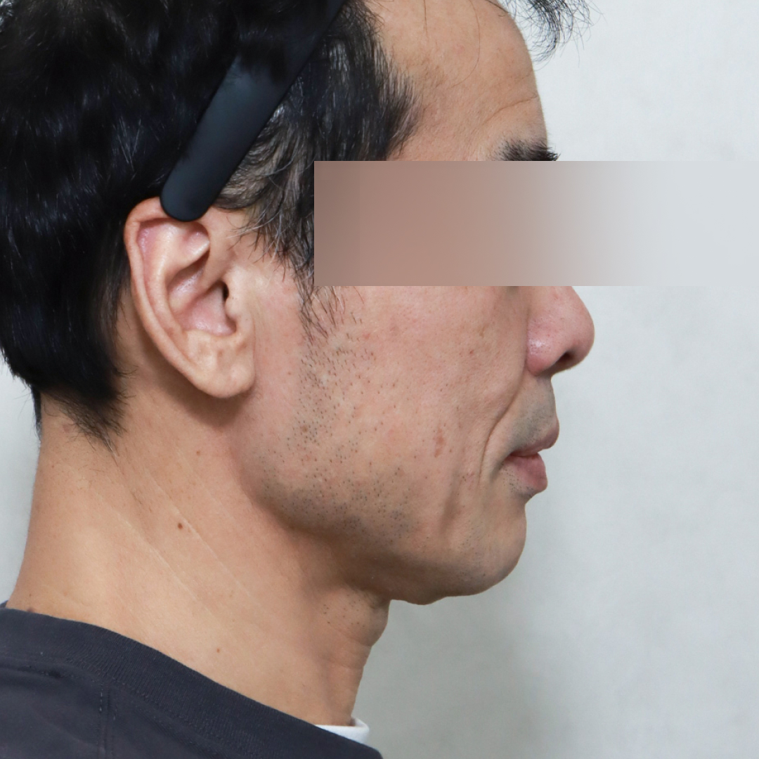 안면거상술 before 90도 이미지