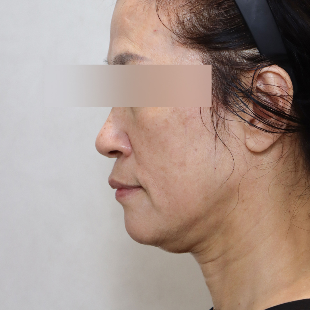 안면거상술 before 90도 이미지