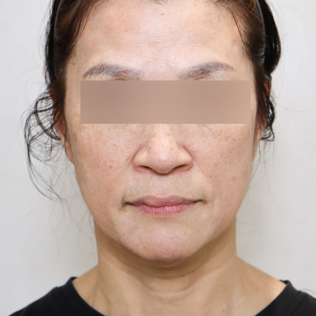 안면거상술 before정면 이미지