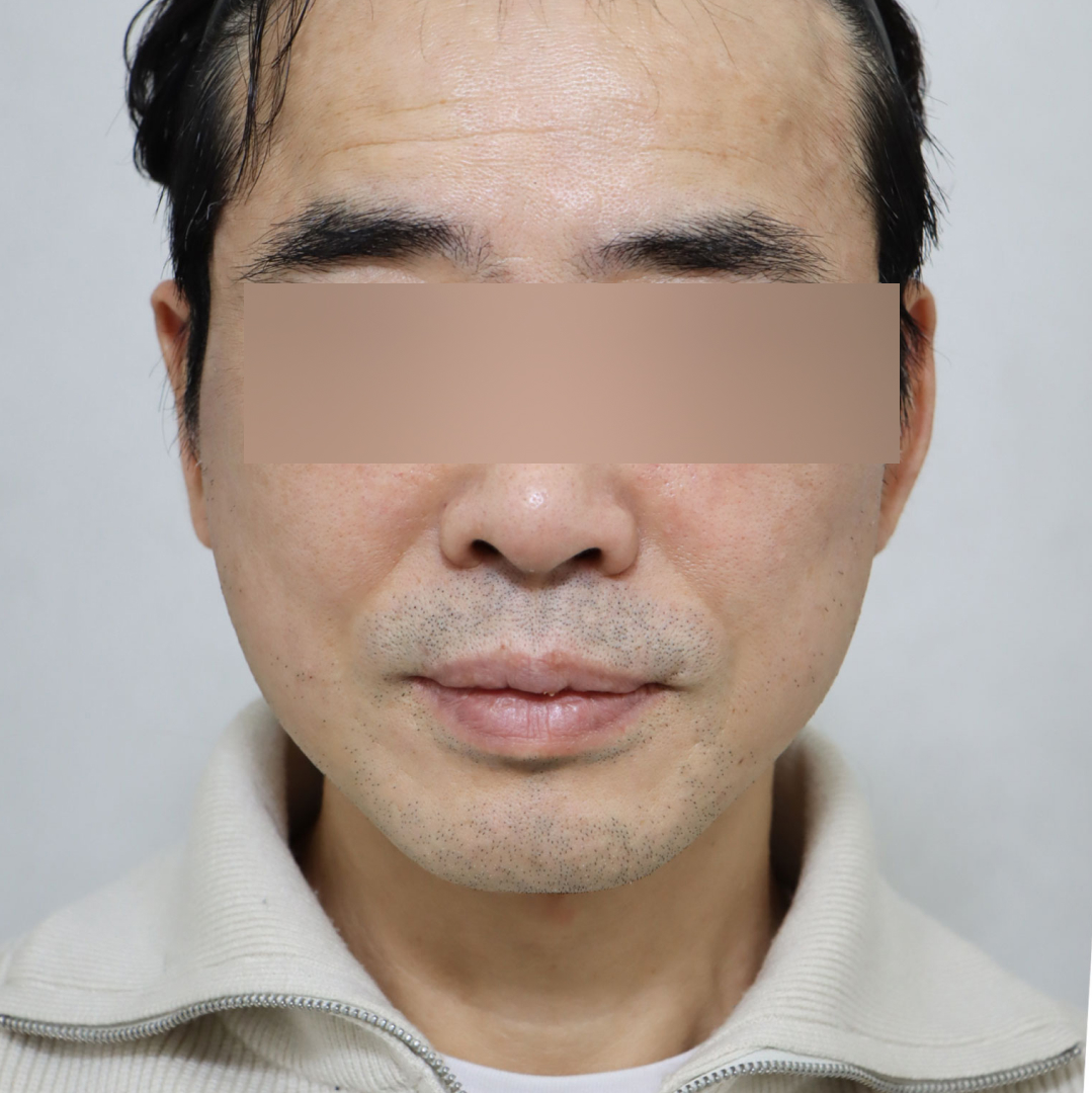 안면거상술 after정면 이미지