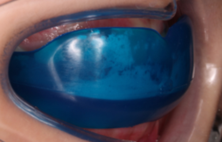 부산 연산동 키다리아저씨치과 어린이교정12