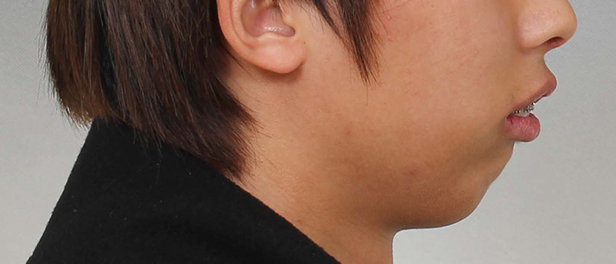 부산 연산동 키다리아저씨치과 치료사례5