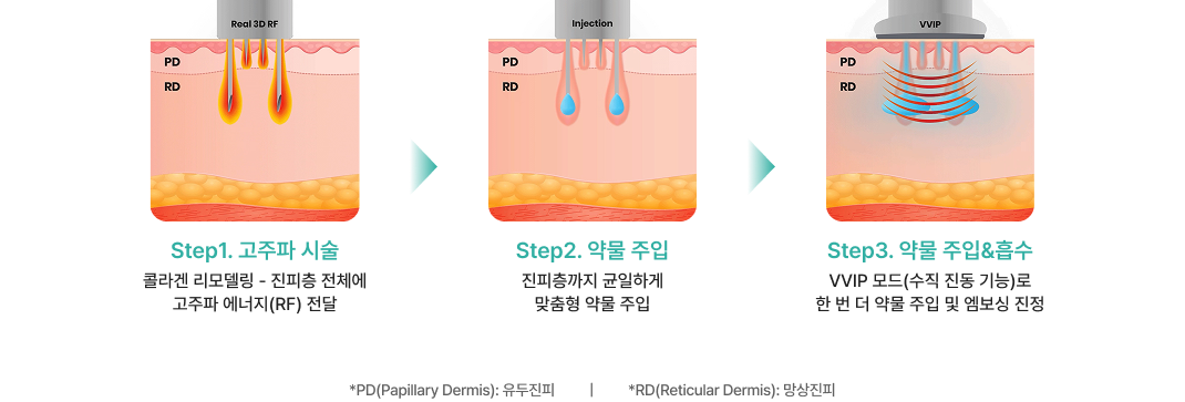 더블타이트 시술 과정