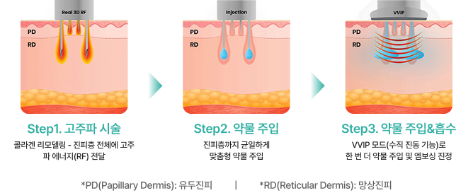 더블타이트 시술 과정