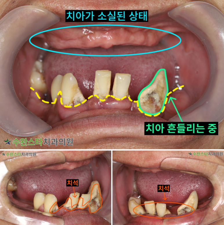 처음 내원 시 구강 내부 사진,  40대 남성 (2025. 11 촬영)