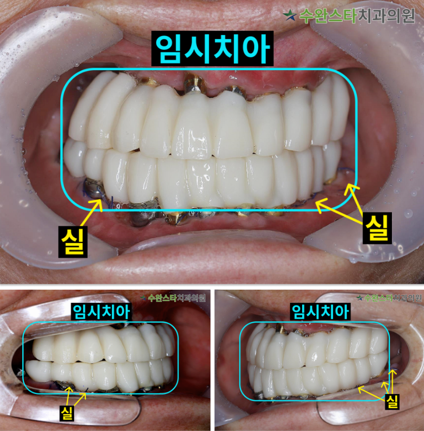 수술 2일 후 임시치아,  60대 여성 (2024. 12촬영)