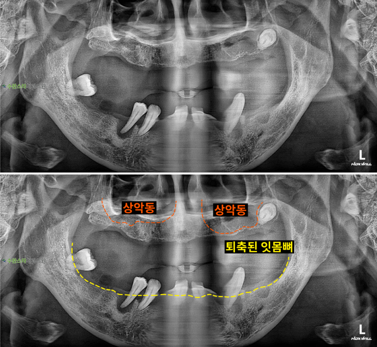 처음 내원 시 파노라마,  40대 남성 (2025. 11 촬영)