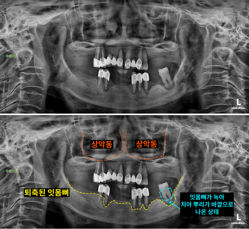 처음 내원 시 파노라마,  60대 여성 (2024. 12촬영) 