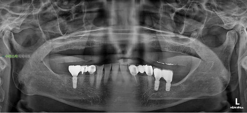 처음 내원 시 파노라마, 70대 여성 (2025. 12촬영) 
