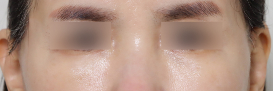 눈성형 After 정면