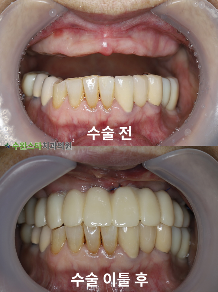 수술 전 / 수술 후 2일 구강 내부  70대 여성 (2025. 12촬영)