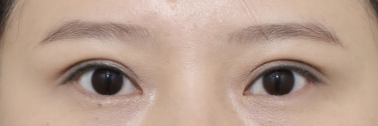 눈성형 After 정면