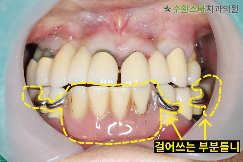 처음 내원 시 구강 내부 사진, 60대 여성 (2024. 12촬영)