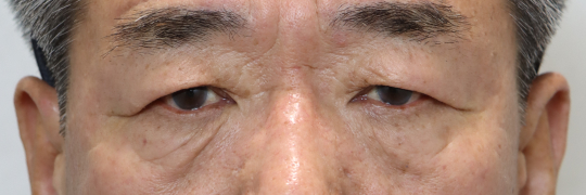 눈성형 Before 정면