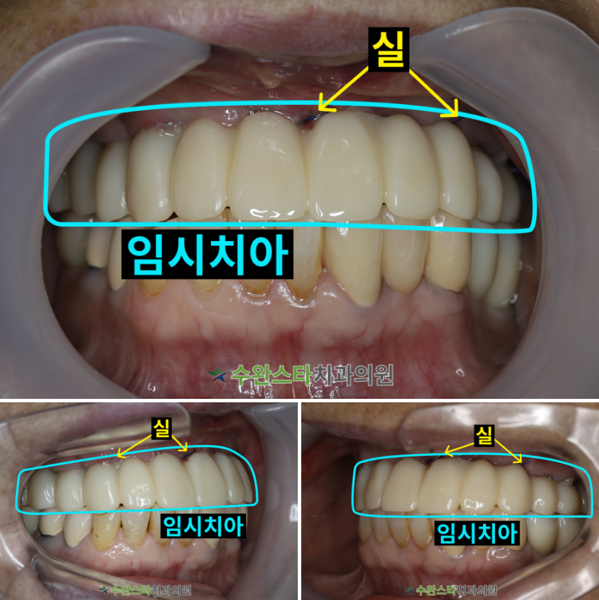 수술 2일 후 임시치아,  70대 여성 (2025. 12촬영)