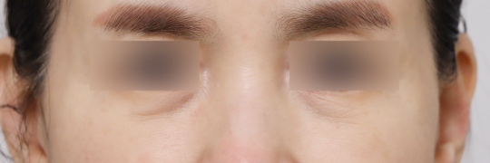 눈성형 Before 정면