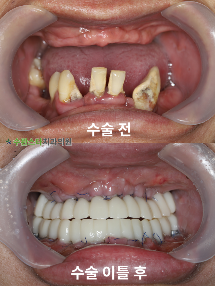 수술 전 / 수술 후 2일 구강 내부,  40대 남성 (2025. 11 촬영)