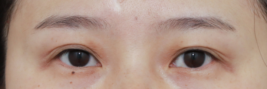 눈성형 Before 정면