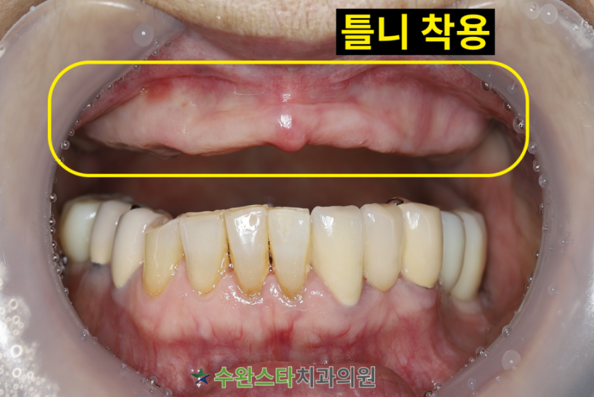 처음 내원 시 구강 내부 사진, 70대 여성 (2025. 12촬영)