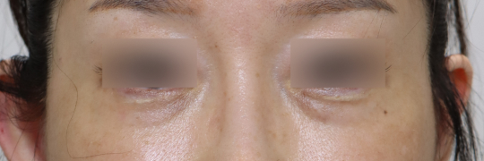 눈성형 Before 정면