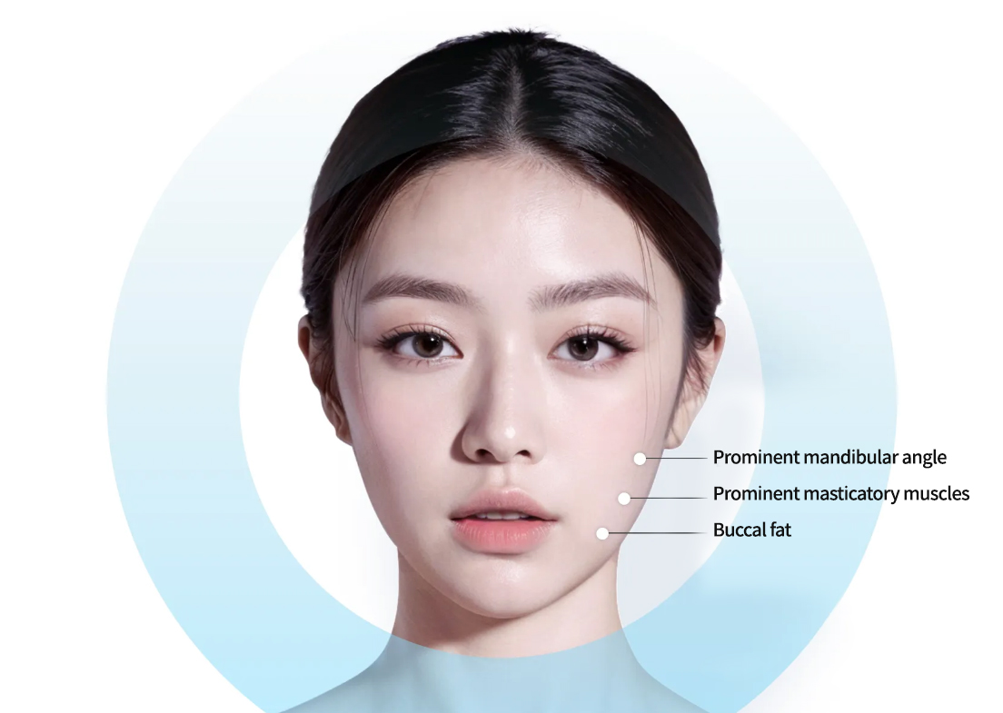 Prominent masticatory muscles Prominent mandibular angle Buccal fat