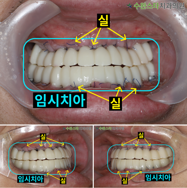 수술 2일 후 임시치아,  40대 남성 (2025. 11 촬영)