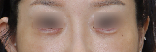 눈성형 After 정면