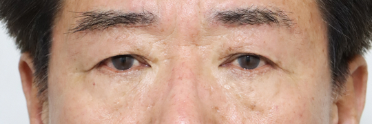 눈성형 After 정면