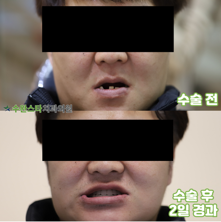 수술 전 / 수술 후 2일 경과,  40대 남성 (2025. 11 촬영)