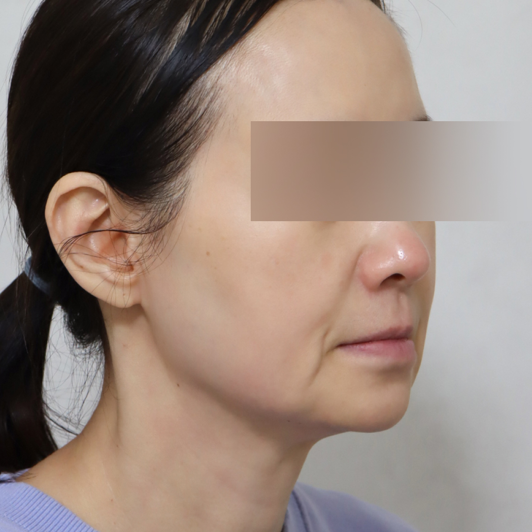 미니거상 before측면 이미지