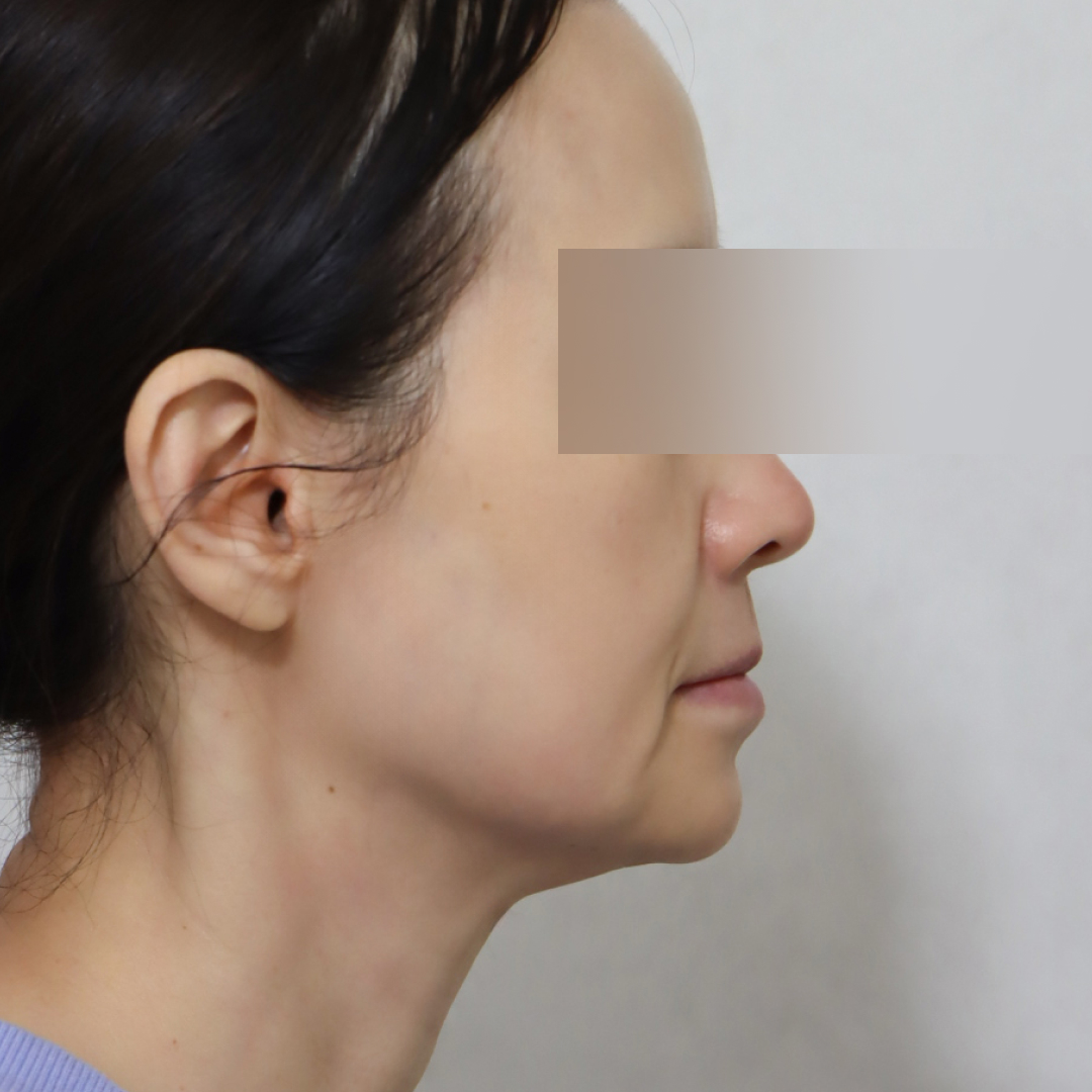 미니거상 before 90도 이미지