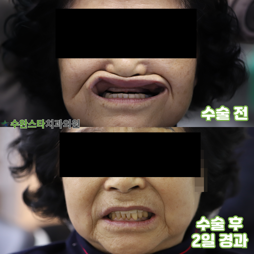 수술 전 / 수술 후 2일 경과, 70대 여성 (2025. 12촬영)