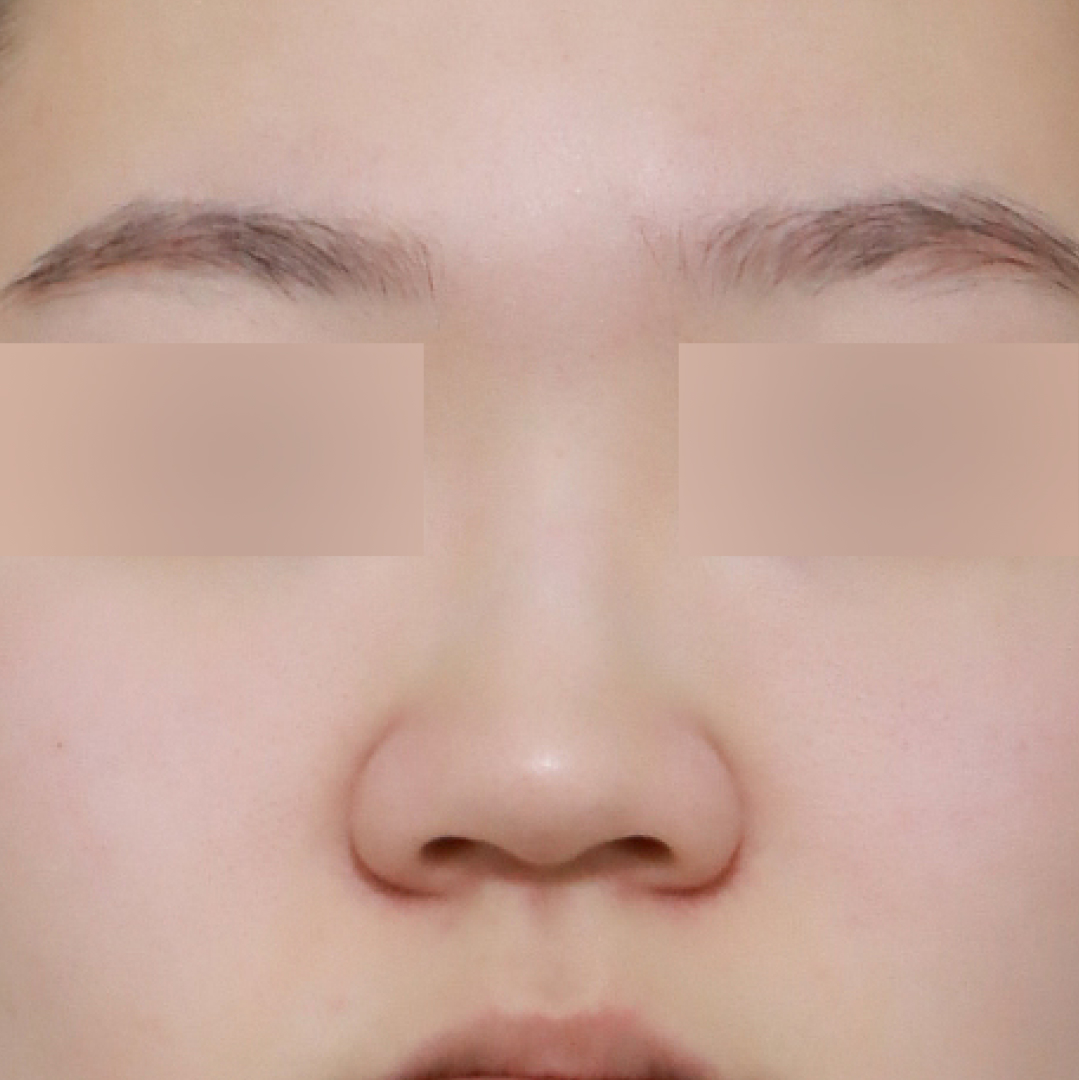 코 before정면 이미지