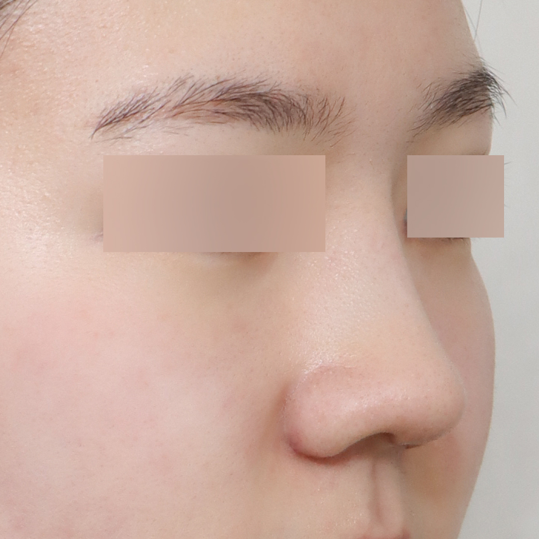 실리프팅 after측면 이미지