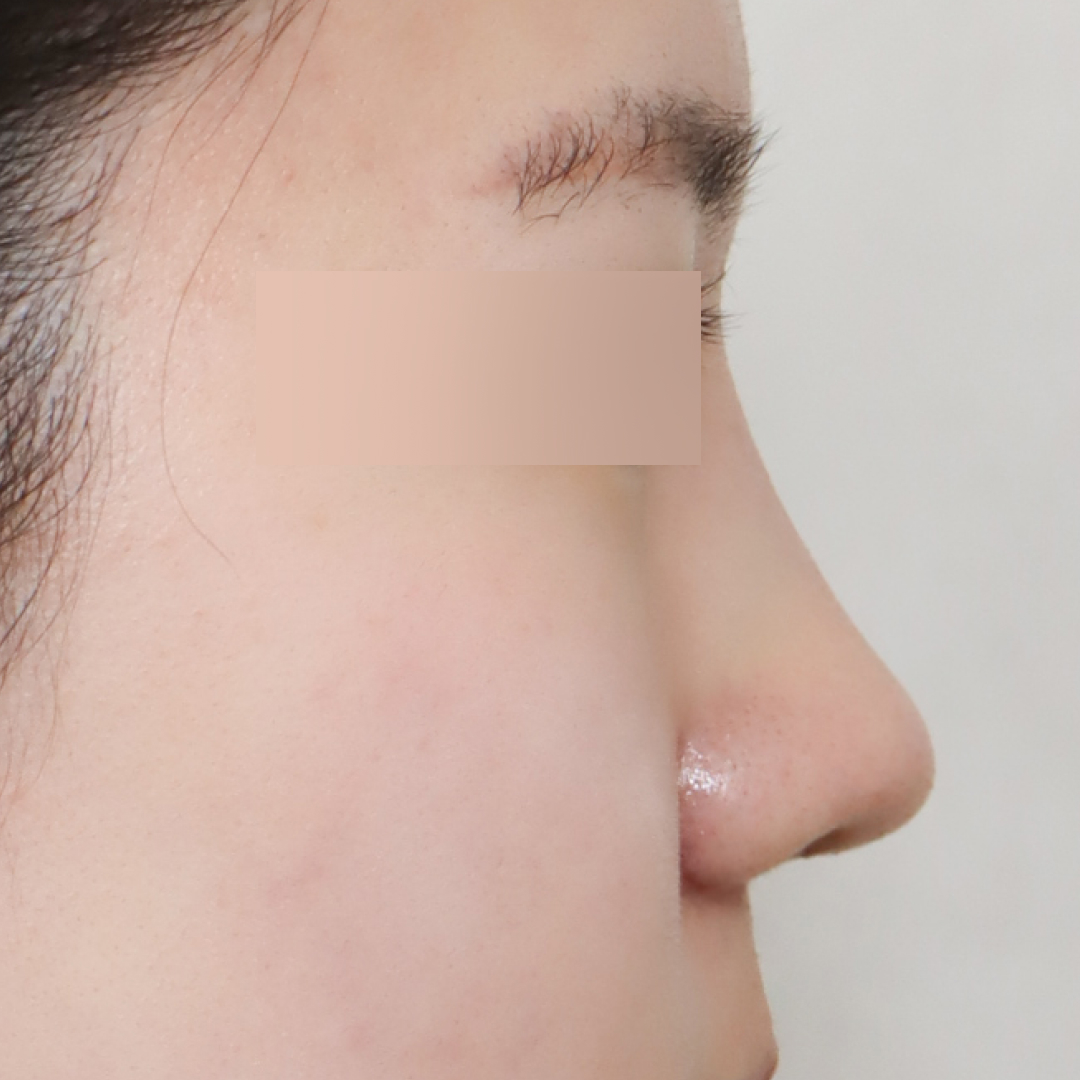 실리프팅 after 90도 이미지