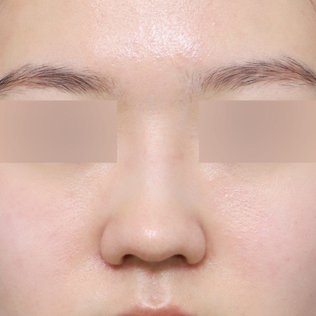 코 after정면 이미지