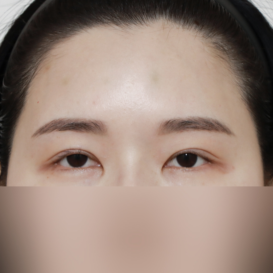 실리프팅 Before 정면