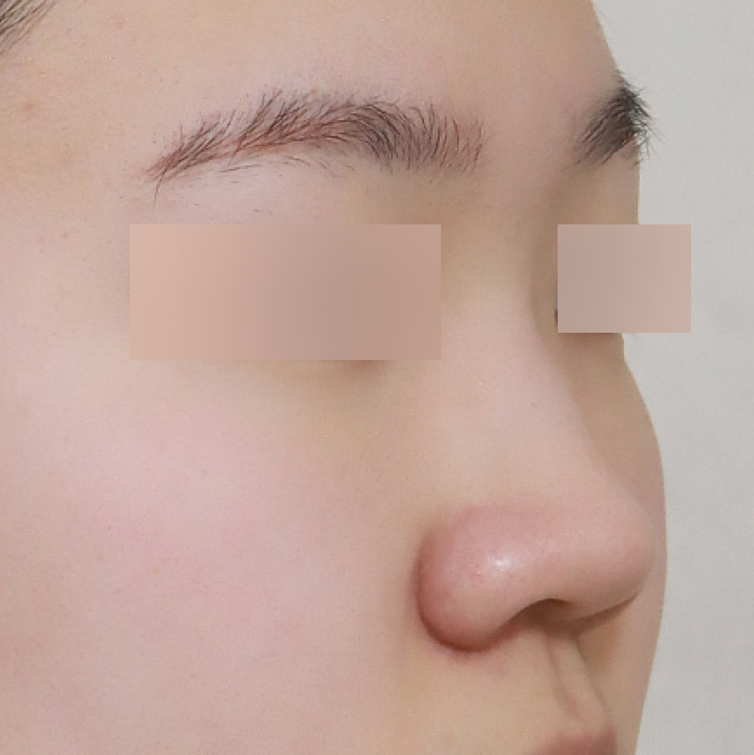 실리프팅 before측면 이미지