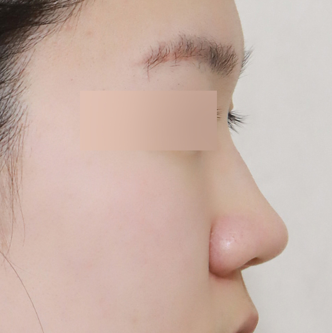 실리프팅 before 90도 이미지