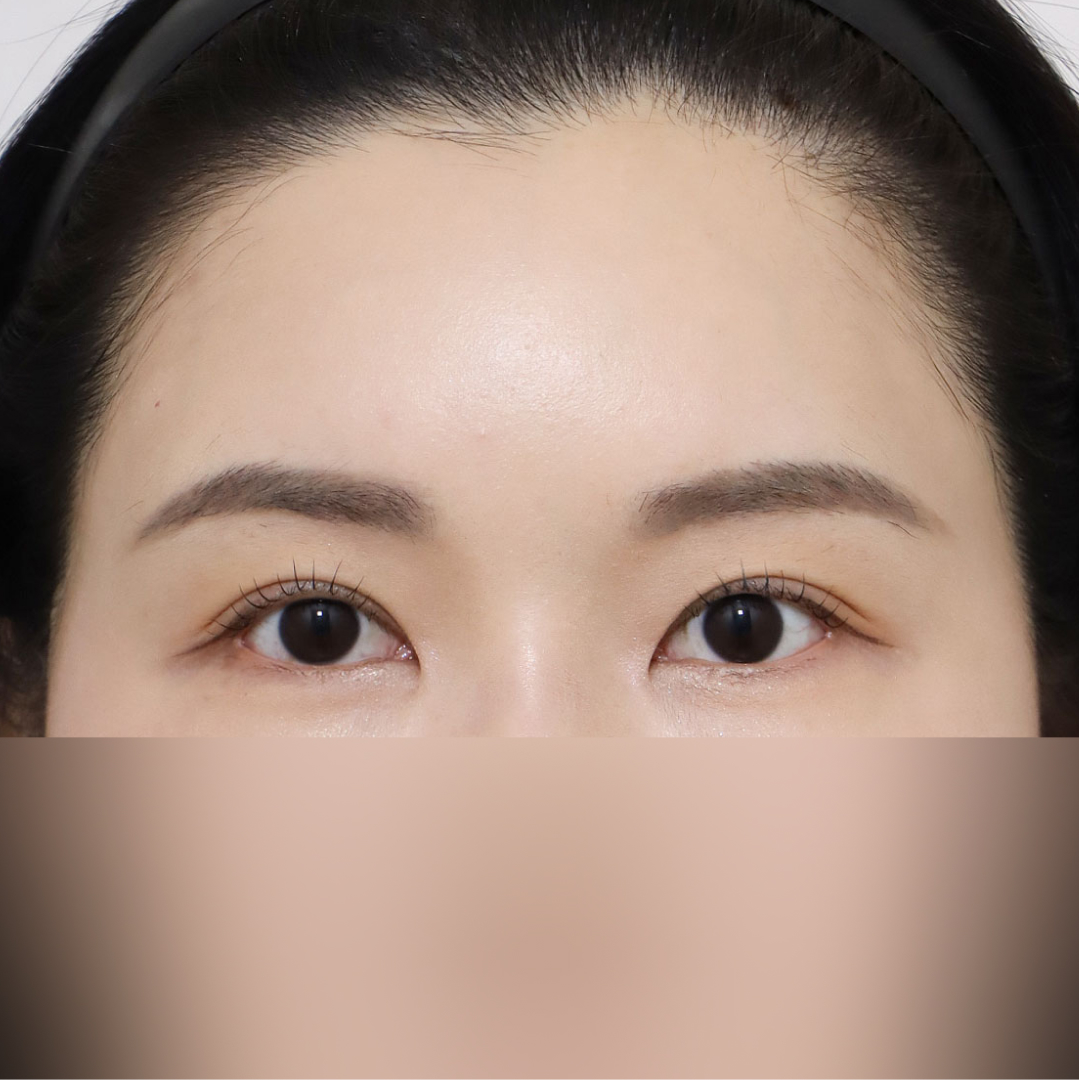 실리프팅 After 정면