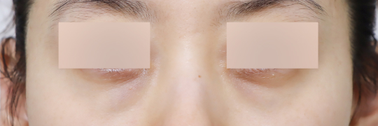 눈성형 Before 정면