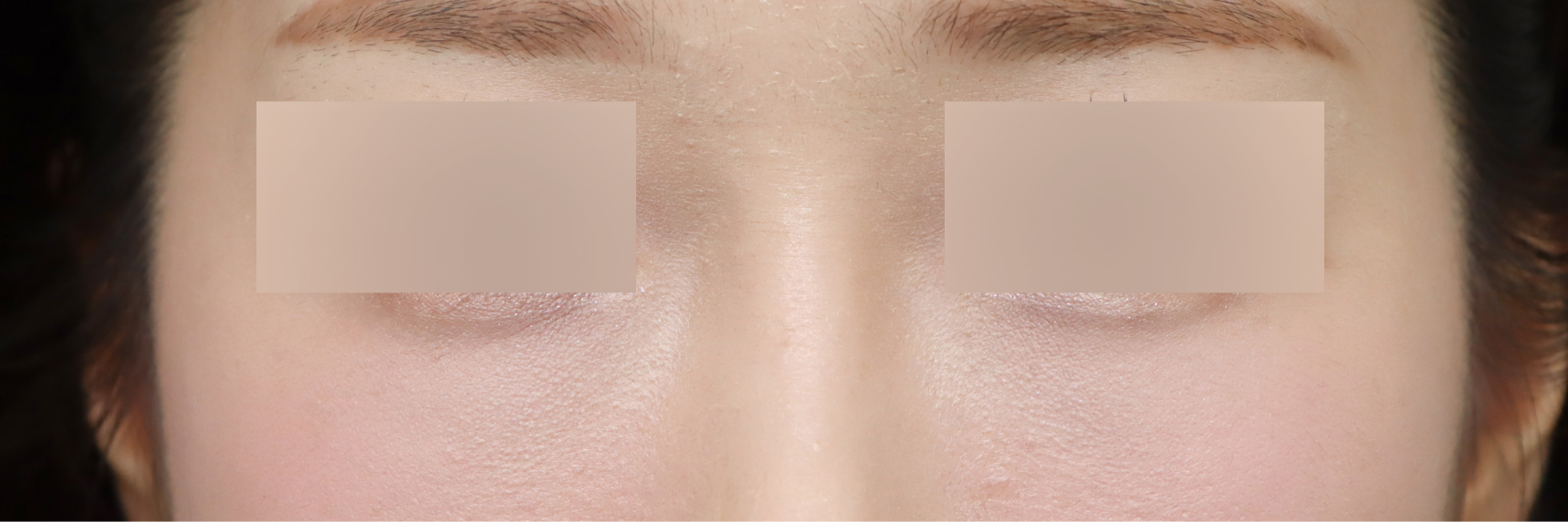 눈성형 After 정면