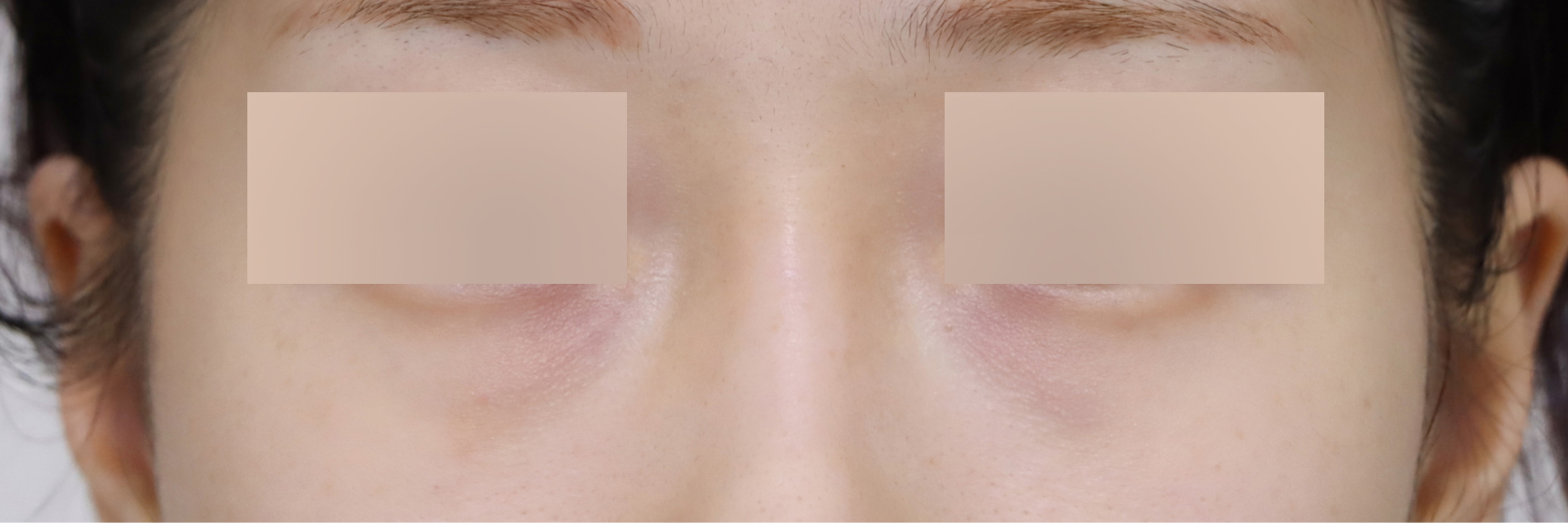 눈성형 Before 정면