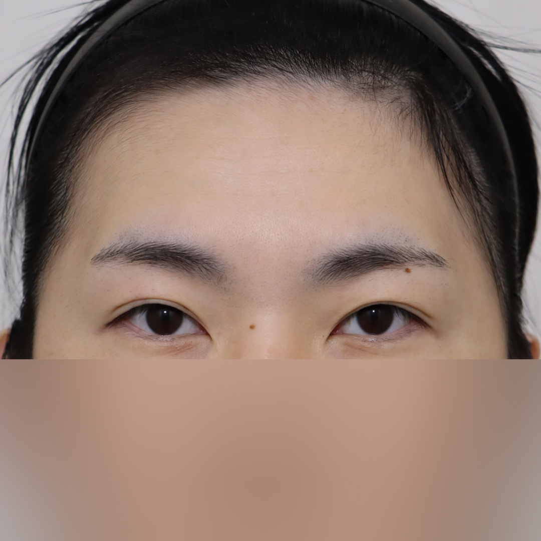 이마거상 Before 정면