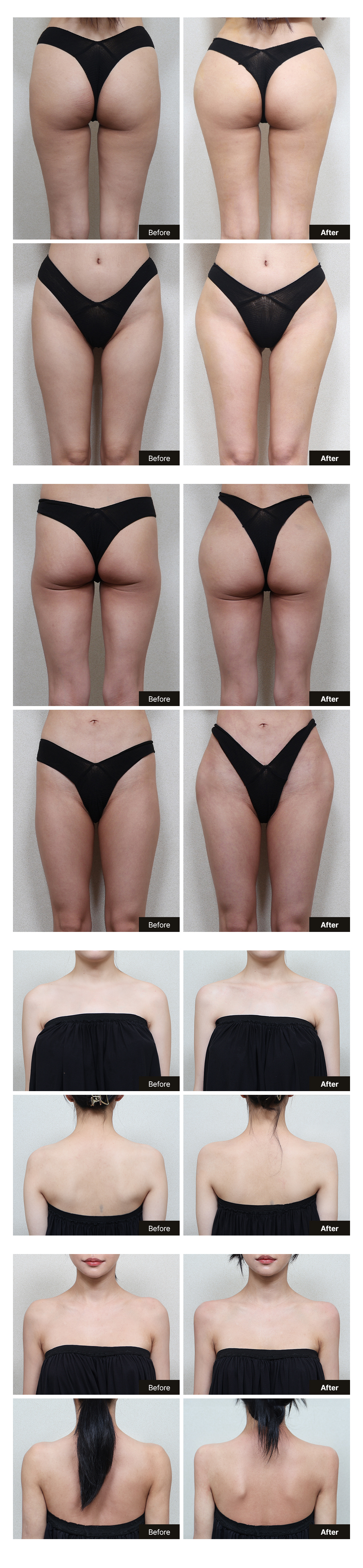 Girin plasticsurgery Body fillers Before and After
