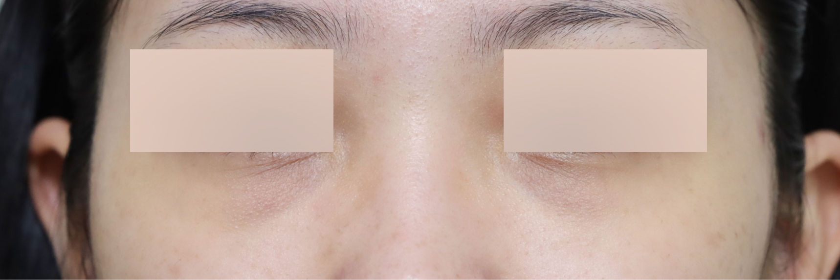 눈성형 Before 정면