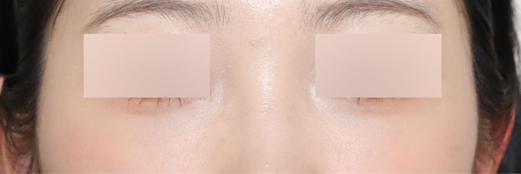 눈성형 After 정면